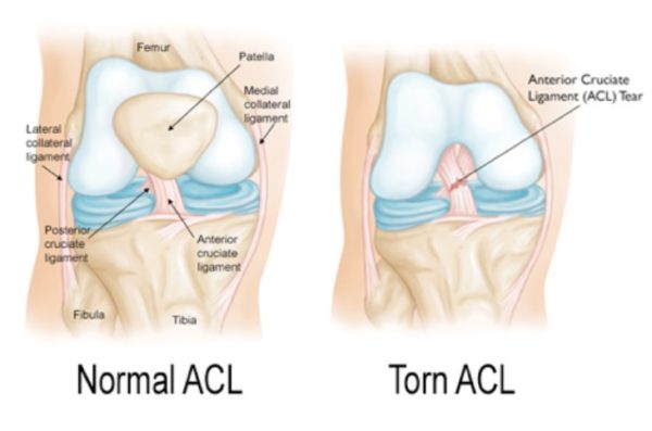 ACL